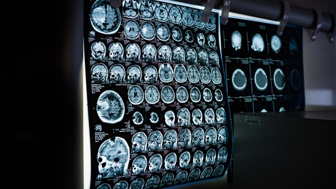 a row of brain scans 